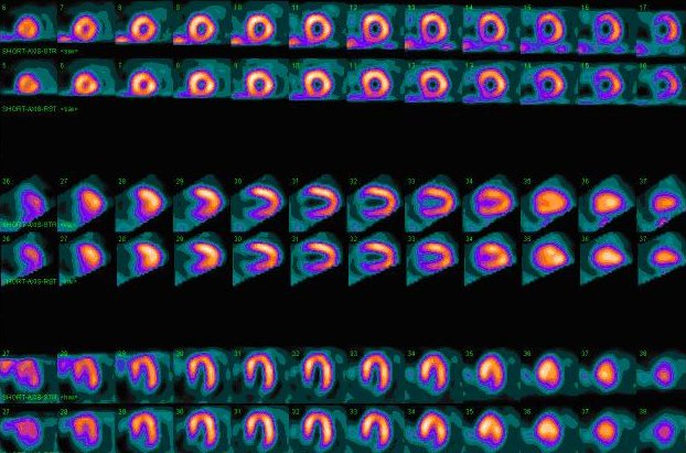 myocardial-perfusion-scans